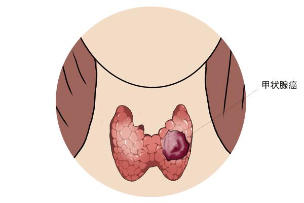 甲狀腺癌癥的主要癥狀表現(xiàn)有什么?為什么會(huì)得甲狀腺癌癥呢? 甲狀腺癌癥的主要癥狀表現(xiàn)有什么?為什么會(huì)得甲狀腺癌癥呢?